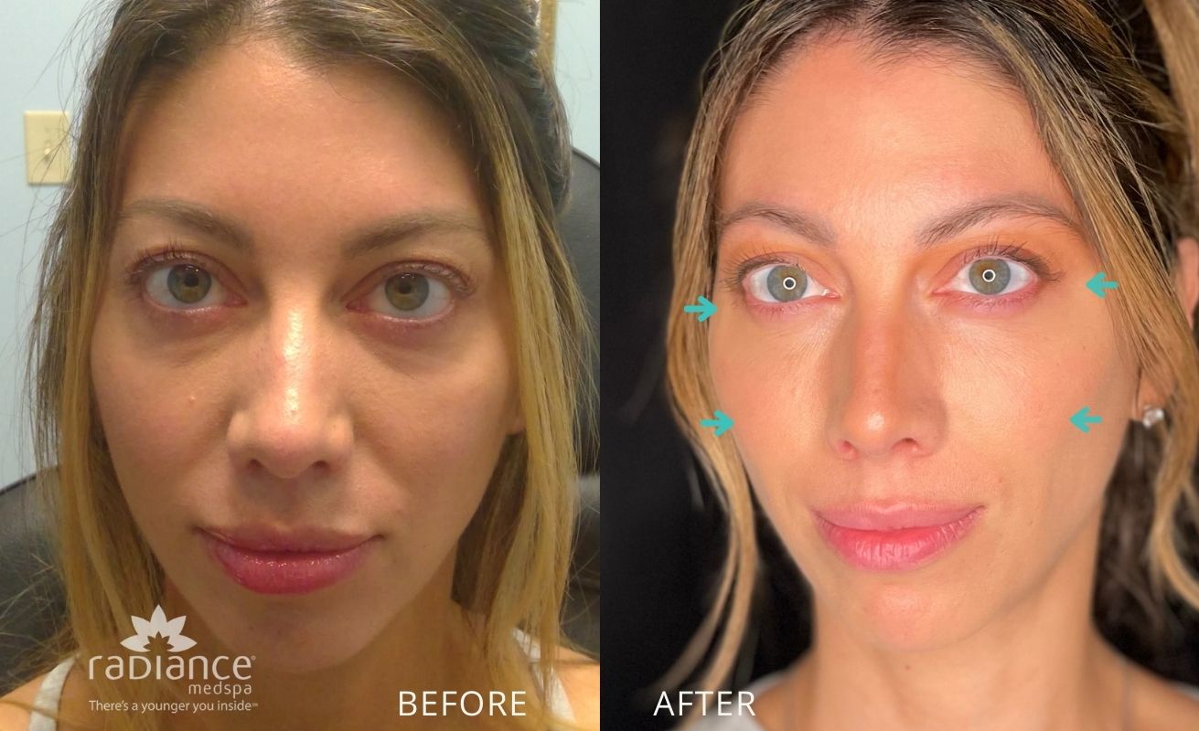 Before and after eye filler treatment Radiance Avon Ct