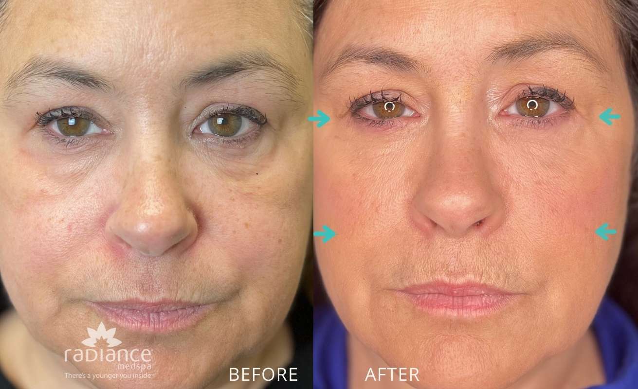 Before and after Ezgel treatment Radiance Avon Ct