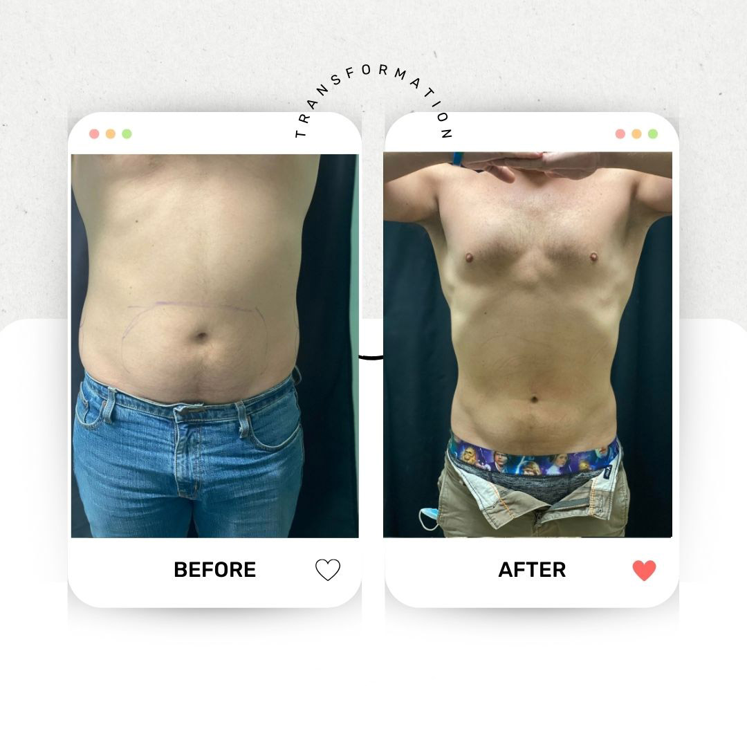 Coolsculpting2 - 1